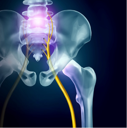 New research: How to Fix Sciatica - Orthopaedics Plus Physical Therapy